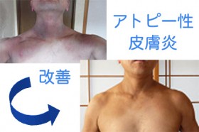 アトピーの原因はダニのふん アトピーの原因はダニのふん